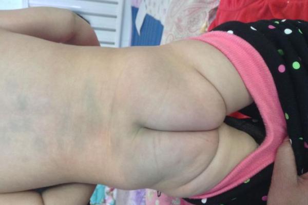 背部胎记算命，背部有胎记会怎样