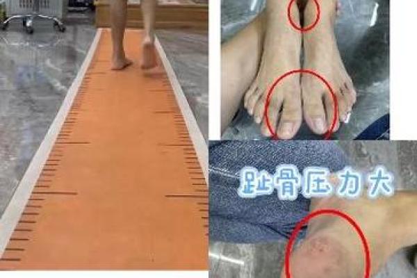 八字型腿 八字型腿