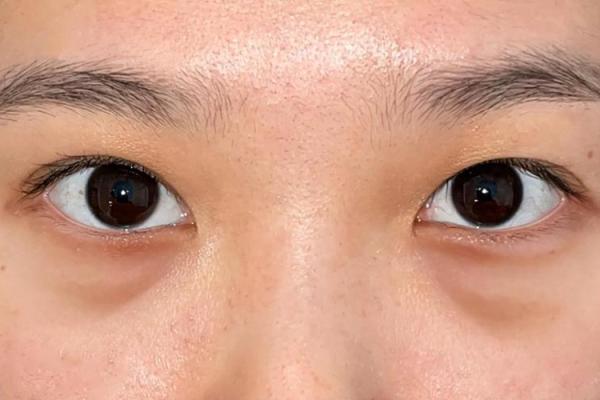 八字眼袋 八字眼袋