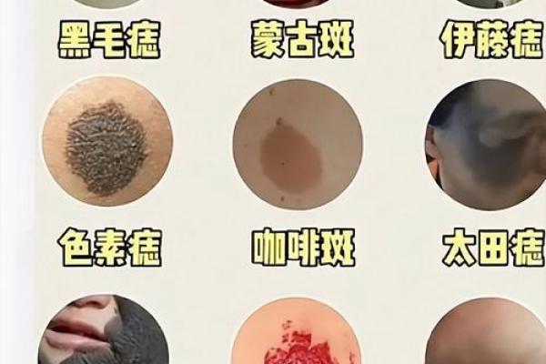 胎记算命图解：什么是红胎记？