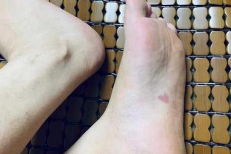 腰部上的胎记如何算命分析？