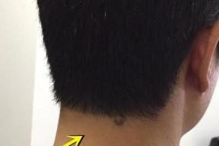 风水上后脑勺长痣代表什么意思