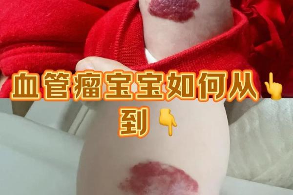 红色胎记算命看危害