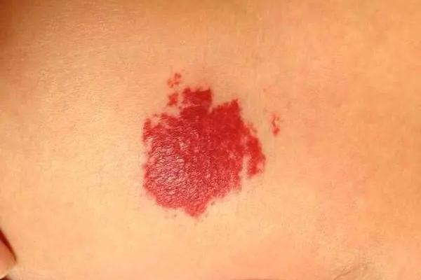 红色胎记算命看危害