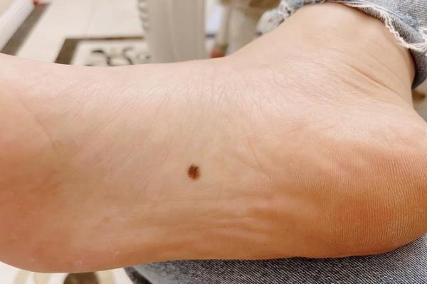 脚底的胎记算命分析 脚底的胎记算命分析