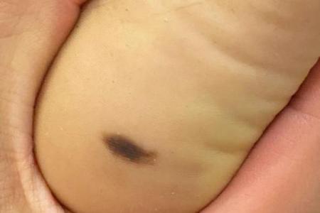 脚底的胎记算命分析