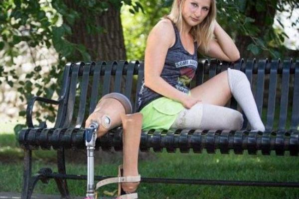 八字肚残疾病原因及预防措施推荐 八字肚残疾病原因及预防措施推荐