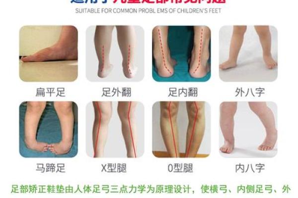 如何纠正内八字脚