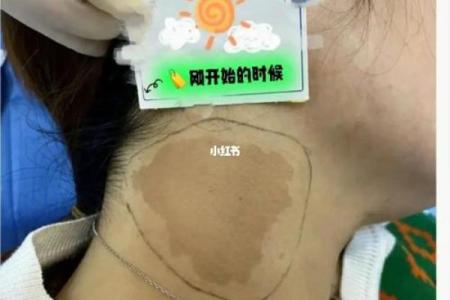 脖子上不同位置胎记算命