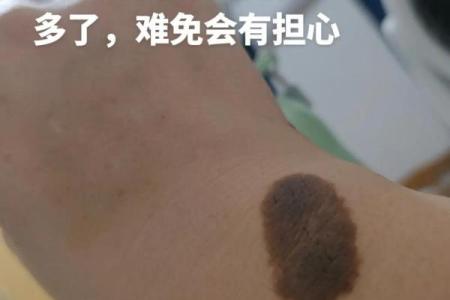 胎记算命：从胎记看运势