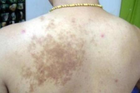 据脖子上胎记算命，有什么说法