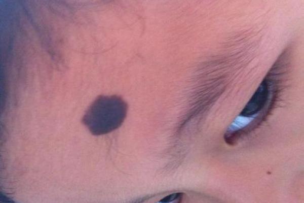 面部不同位置的胎记算命 面部不同位置的胎记算命